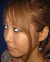 DR 近藤　こだわりのラディエッセ注入　鼻尖形成