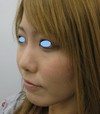 DR 近藤　こだわりのラディエッセ注入　鼻尖形成