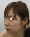 最新鋭　プラズマリポレーザーを用いた　切らない小顔術：プラズマリポ・レーザーメソセラピー
