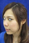 最新鋭　プラズマリポレーザーを用いた　切らない小顔術：プラズマリポ・レーザーメソセラピー