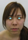 最新鋭　プラズマリポレーザーを用いた　切らない小顔術：プラズマリポ・レーザーメソセラピー