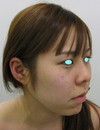 最新鋭　プラズマリポレーザーを用いた　切らない小顔術：プラズマリポ・レーザーメソセラピー