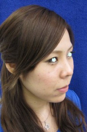 最新鋭　プラズマリポレーザーを用いた　切らない小顔術：プラズマリポ・レーザーメソセラピー