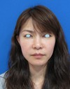 自分の血液から作るジェルで　活き活きチーク！　PPP-GEL注入療法