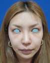 自己血からつくる「PPP-GEL」注入療法（ゴルゴライン・チーク）+　ラディエッセ注入（アゴ）で　プチ整形！