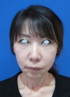 ゴルゴライン、張りのないチークにお悩みの方に！自己血から作る注入ゲルで最先端若返りを！！