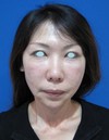 ゴルゴライン、張りのないチークにお悩みの方に！自己血から作る注入ゲルで最先端若返りを！！