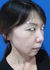 ゴルゴライン、張りのないチークにお悩みの方に！自己血から作る注入ゲルで最先端若返りを！！