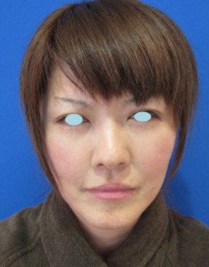 先端若返り美容医療　自分の血液から作るゲルで　活き活きチーク！　PPP-GEL注入療法！！