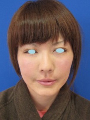 先端若返り美容医療　自分の血液から作るゲルで　活き活きチーク！　PPP-GEL注入療法！！
