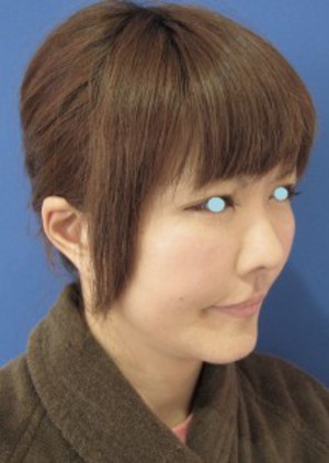最先端若返り美容医療　自分の血液から作るゲルで　活き活きチークを！　PPP-GEL注入療法！！