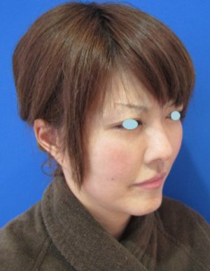 最先端若返り美容医療　自分の血液から作るゲルで　活き活きチークを！　PPP-GEL注入療法！！