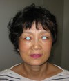 私の目指す　美容医療　最小侵襲アンチエイジング外科　MIAS：　DR.近藤オリジナル　切らないお顔の引き上げ術　チタンペックリフト