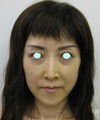 私の目指す美容医療　最小侵襲美容外科　MIAS：Dr.近藤オリジナル　切らないお顔の引き上げ術　チタンペックリフト