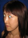 私の目指す美容医療　最小侵襲美容外科　MIAS：Dr.近藤オリジナル　切らないお顔の引き上げ術　チタンペックリフト