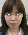 私の目指す美容医療　MIAS：　DR近藤オリジナル切らないお顔の引き上げ術　チタンペックリフト　＋　自分の血液から作るゲル（PPP-GEL）のチークへの注入