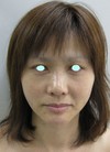 私の目指す美容医療　最小侵襲美容外科　MIAS：Dr.近藤オリジナル　切らないお顔の引き上げ術　チタンペックリフト