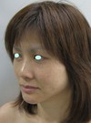 私の目指す美容医療　最小侵襲美容外科　MIAS：Dr.近藤オリジナル　切らないお顔の引き上げ術　チタンペックリフト