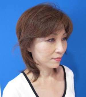 私の目指す美容外科　MIAS：最小侵襲アンチエイジング外科　DR　近藤オリジナル　切らないお顔の引き上げ術　チタンペックリフト®