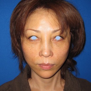 DR 近藤オリジナル　切らないお顔の引き上げ術　チタンペックリフト