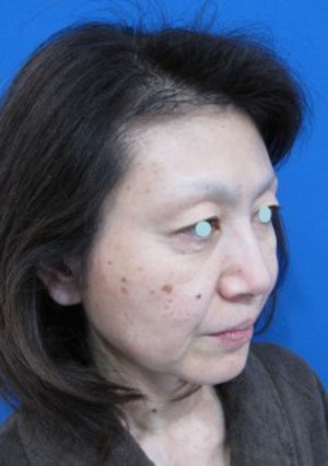 DR 近藤オリジナル　切らないお顔の引き上げ術　チタンペックリフト　