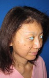 DR 近藤オリジナル　切らないお顔の引き上げ術　チタンペックリフト　