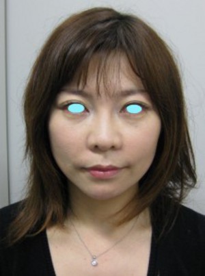 私の目指す美容医療　最小侵襲美容外科　MIAS：Dr　近藤オリジナル　切らないお顔の引き上げ術　チタンペックリフト