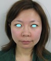 私の目指す美容医療　最小侵襲美容外科　MIAS：Dr　近藤オリジナル　切らないお顔の引き上げ術　チタンペックリフト