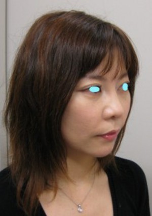 私の目指す美容医療　最小侵襲美容外科　MIAS：Dr　近藤オリジナル　切らないお顔の引き上げ術　チタンペックリフト