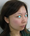 私の目指す美容医療　最小侵襲美容外科　MIAS：Dr　近藤オリジナル　切らないお顔の引き上げ術　チタンペックリフト