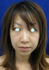 DR　近藤オリジナル　切らないお顔の引き上げ術　チタンペックリフト・簡易型　クイックチタンペックリフト