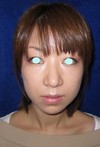 DR　近藤オリジナル　切らないお顔の引き上げ術　チタンペックリフト・簡易型　クイックチタンペックリフト