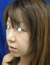 DR　近藤オリジナル　切らないお顔の引き上げ術　チタンペックリフト・簡易型　クイックチタンペックリフト