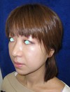 DR　近藤オリジナル　切らないお顔の引き上げ術　チタンペックリフト・簡易型　クイックチタンペックリフト