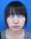 DR.近藤　こだわりのプチ整形　たった数分でこんなに素敵に！　顎のラディエッセ注入