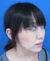 DR　近藤　こだわりのプチ整形　たった数分でこんなに素敵に！　顎のラディエッセ注入