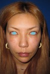 自己血からつくる「PPP-GEL」注入療法（ゴルゴライン・チーク）+　ラディエッセ注入（アゴ）で　プチ整形！