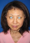 DR　近藤オリジナル　切らないお顔の引き上げ術　チタンペックリフト