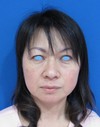 DR 近藤オリジナル　切らないお顔の引き上げ術　チタンペックリフト　術6週後