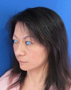 私の目指す美容医療　最小侵襲美容外科　MIAS：Dr.近藤オリジナル　切らないお顔の引き上げ術　チタンペックリフト