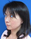 私の目指す美容医療　最小侵襲美容外科　MIAS：Dr.近藤オリジナル　切らないお顔の引き上げ術　チタンペックリフト