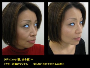 私の目指す　美容医療　MIAS　：切らない目の下のクマ・たるみ取り　+　顎　法令線のラディエッセ