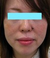 自己の血液からつくるGELで最新若返り！！　PPP-GEL注入療法　チーク・法令線