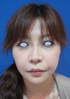 DR.近藤オリジナル　切らないお顔の引き上げ術　チタンペックリフト　長期経過写真