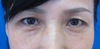 手術顕微鏡使用・極細糸を用いた　切らない目の上のたるみとり　（SO　クイックたるみとり）