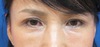 手術顕微鏡使用・極細糸を用いた　切らない目の上のたるみとり　（SO　クイックたるみとり）