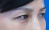 手術顕微鏡使用・極細糸を用いた　切らない目の上のたるみとり　（SO　クイックたるみとり）