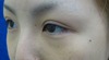 DR.近藤　こだわりの目頭切開（手術顕微鏡使用）