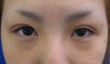 DR.近藤　こだわりの目頭切開（手術顕微鏡使用）