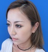 その方本来の美しさを引き出すプチ整形・　二重術＆アゴ・鼻